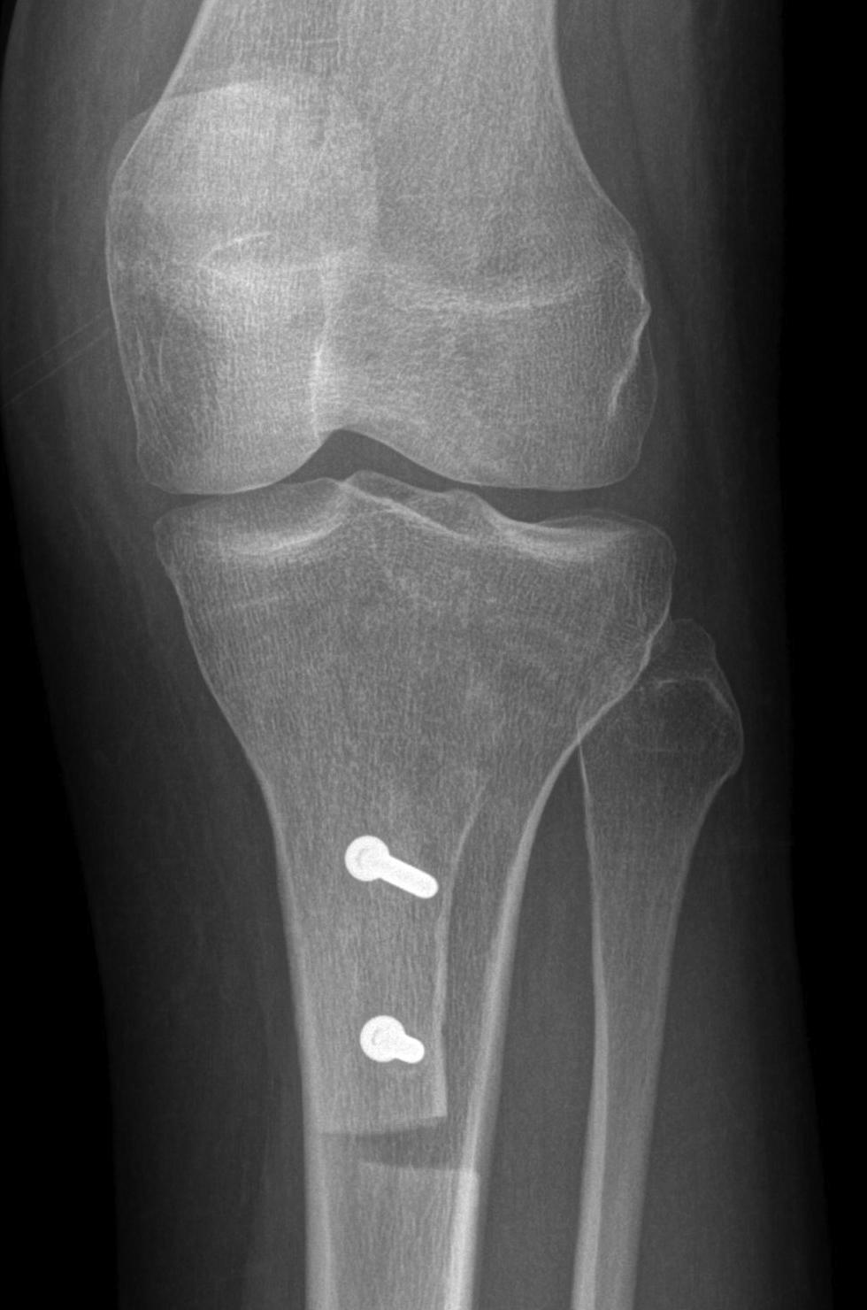 Chronic Patella Dislocation